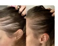 Before and after scalp photo from Amanda C.'s review